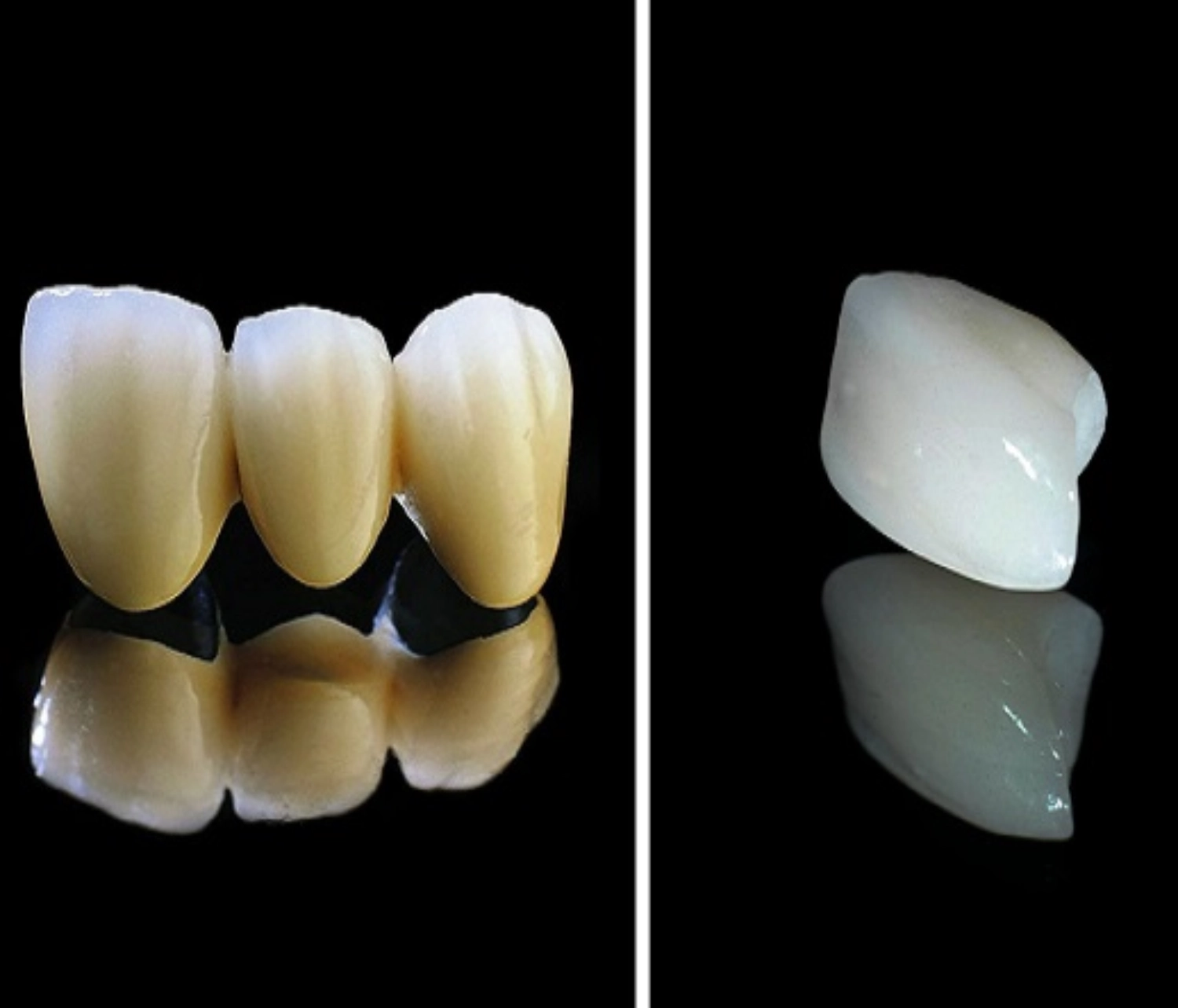 So sánh răng sứ titan và răng toàn sứ: Cấu tạo, thẩm mỹ, độ bền & giá